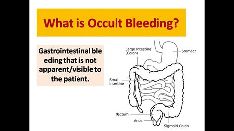 The Hem Occult Blood Test: A Vital Screening Tool for Gastrointestinal Disorders